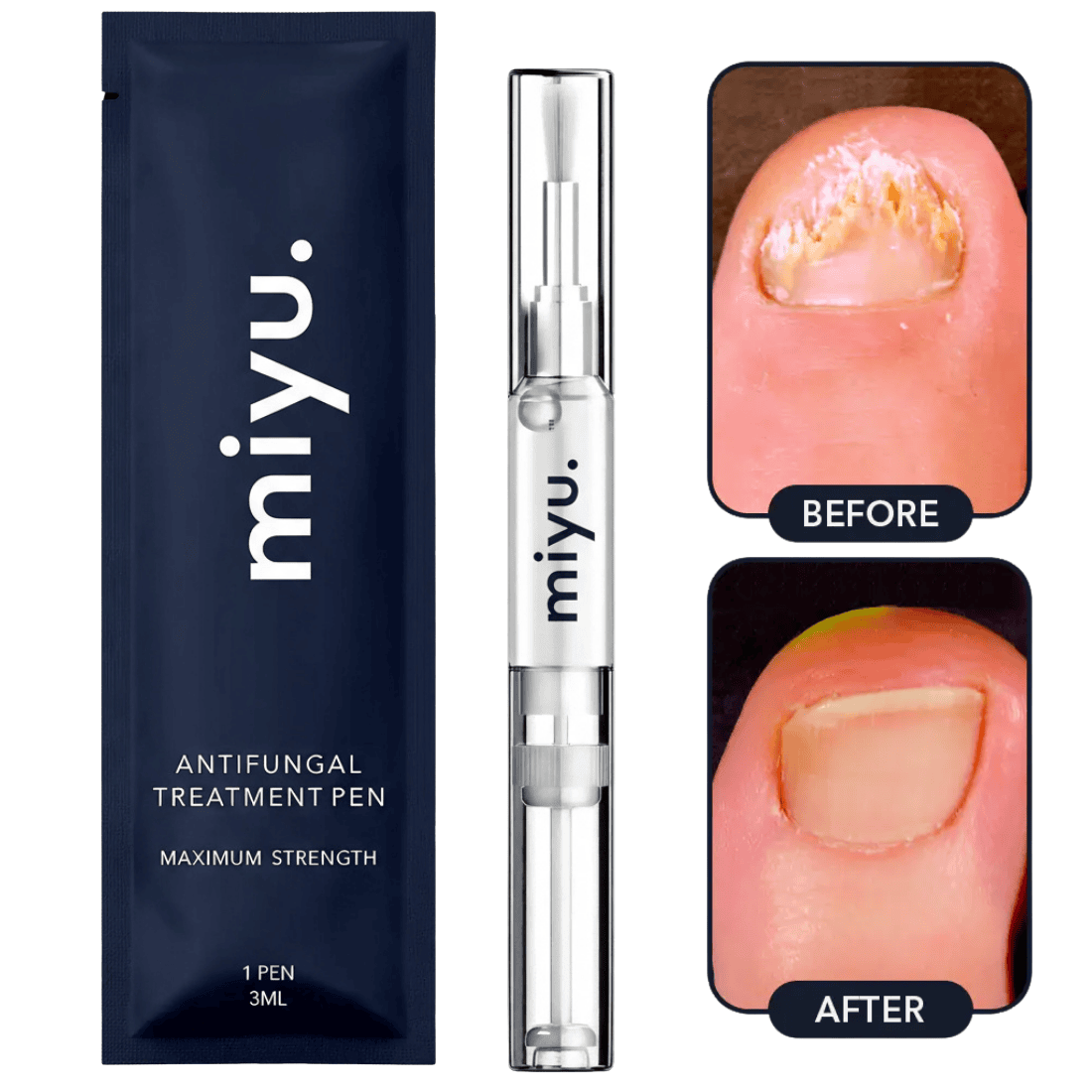 Miyu Antifungal Treatment Pen